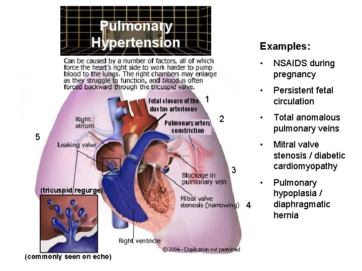 Pulmonary Hypertension Fetal closure of the ductus arteriosus Examples: 1 Pulmonary artery constriction 5