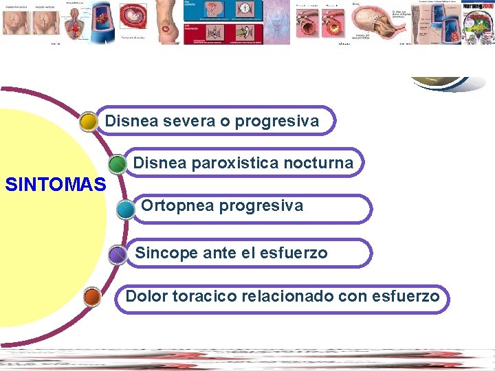 Contents www. thmemgallery. com Disnea severa o progresiva Disnea paroxistica nocturna SINTOMAS Ortopnea progresiva