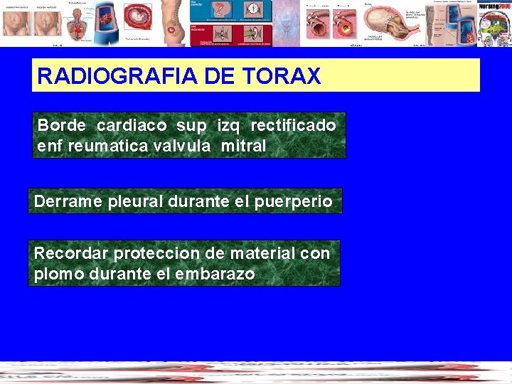 RADIOGRAFIA DE TORAX Borde cardiaco sup izq rectificado enf reumatica valvula mitral Derrame pleural