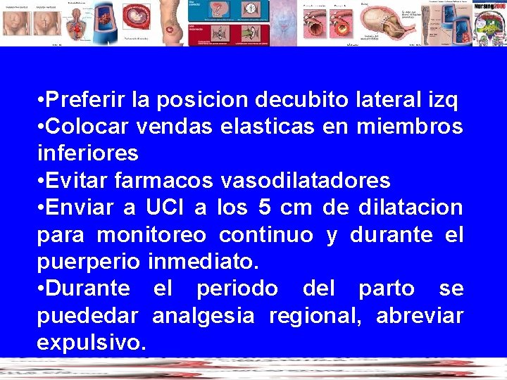  • Preferir la posicion decubito lateral izq • Colocar vendas elasticas en miembros