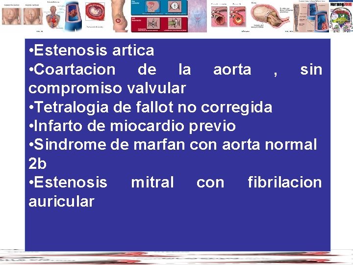  • Estenosis artica • Coartacion de la aorta , sin compromiso valvular •