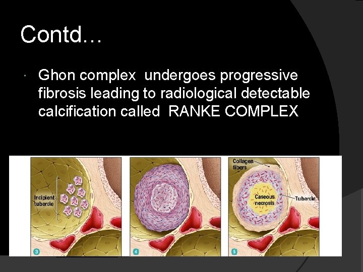 Contd… Ghon complex undergoes progressive fibrosis leading to radiological detectable calcification called RANKE COMPLEX