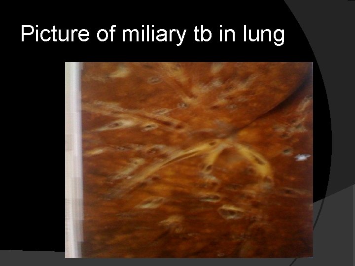 Picture of miliary tb in lung 