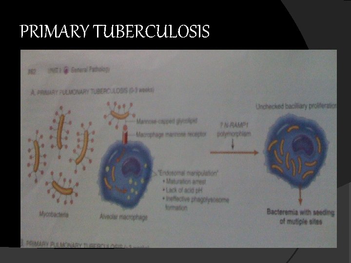 PRIMARY TUBERCULOSIS 