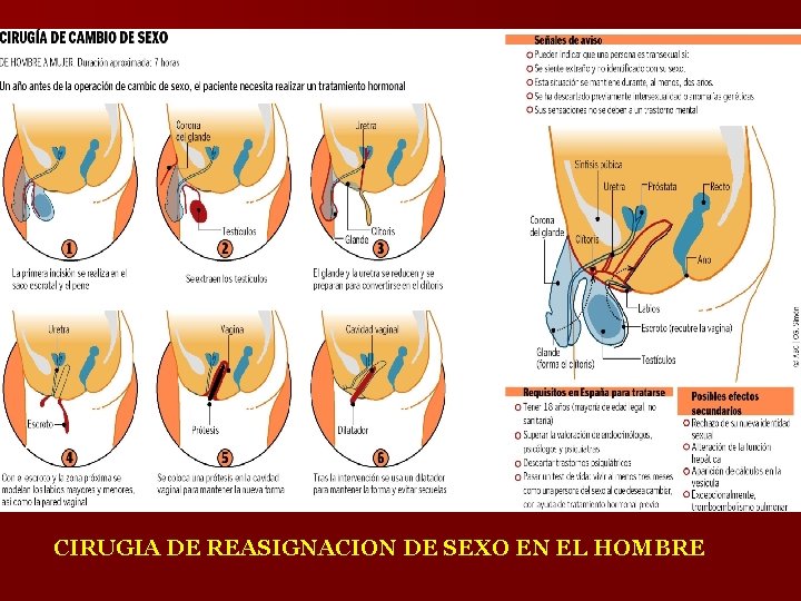 CIRUGIA DE REASIGNACION DE SEXO EN EL HOMBRE 