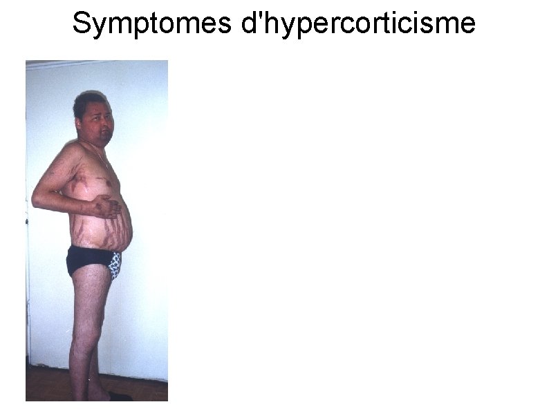 Symptomes d'hypercorticisme 