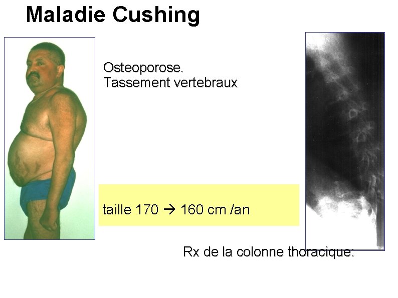 Maladie Cushing Osteoporose. Tassement vertebraux taille 170 160 cm /an Rx de la colonne