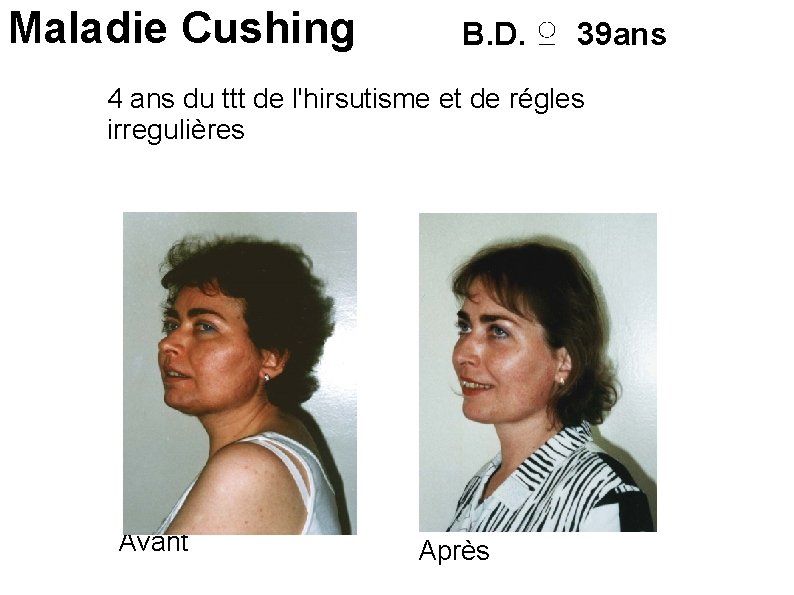 Maladie Cushing B. D. ♀ 39 ans 4 ans du ttt de l'hirsutisme et