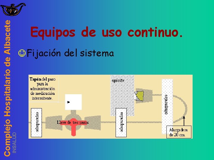 INSALUD Complejo Hospitalario de Albacete Equipos de uso continuo. JFijación del sistema 