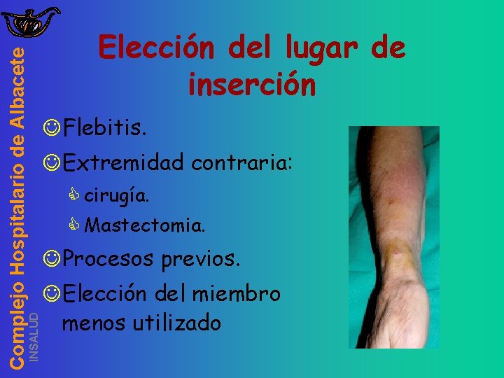 INSALUD Complejo Hospitalario de Albacete Elección del lugar de inserción JFlebitis. JExtremidad contraria: C