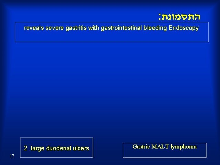 : התסמונת reveals severe gastritis with gastrointestinal bleeding Endoscopy 2 large duodenal ulcers 17