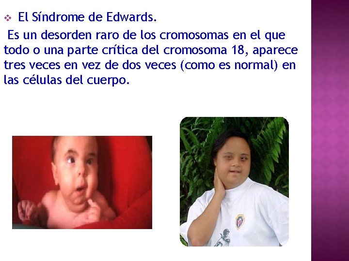 El Síndrome de Edwards. Es un desorden raro de los cromosomas en el que