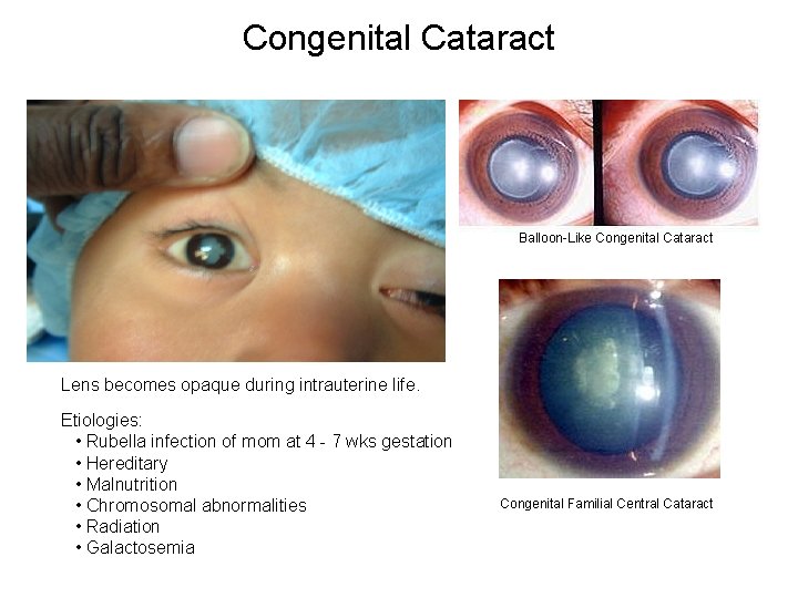 Congenital Cataract Balloon-Like Congenital Cataract Lens becomes opaque during intrauterine life. Etiologies: • Rubella