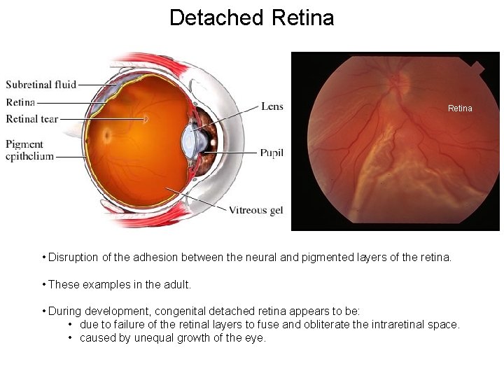 Detached Retina Iris of right eye • Disruption of the adhesion between the neural