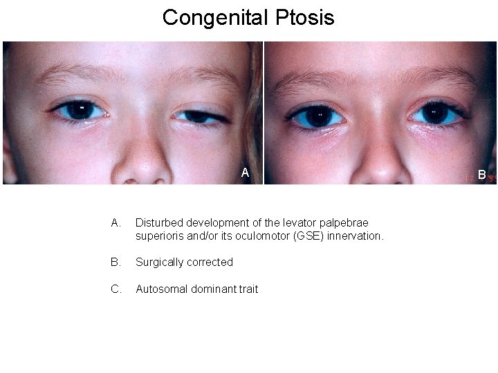 Congenital Ptosis Iris of right eye Retina A A. Disturbed development of the levator