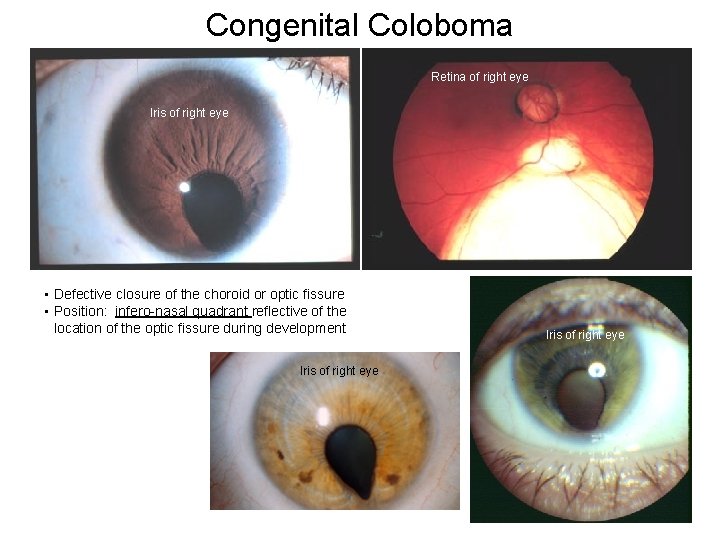 Congenital Coloboma Retina of right eye Iris of right eye • Defective closure of