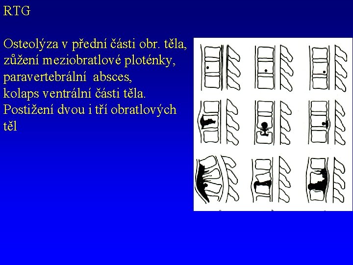 RTG Osteolýza v přední části obr. těla, zůžení meziobratlové ploténky, paravertebrální absces, kolaps ventrální
