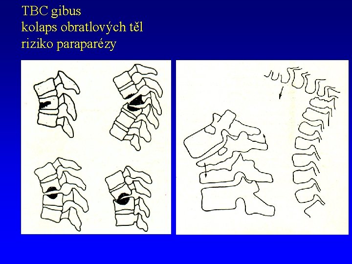 TBC gibus kolaps obratlových těl riziko paraparézy 