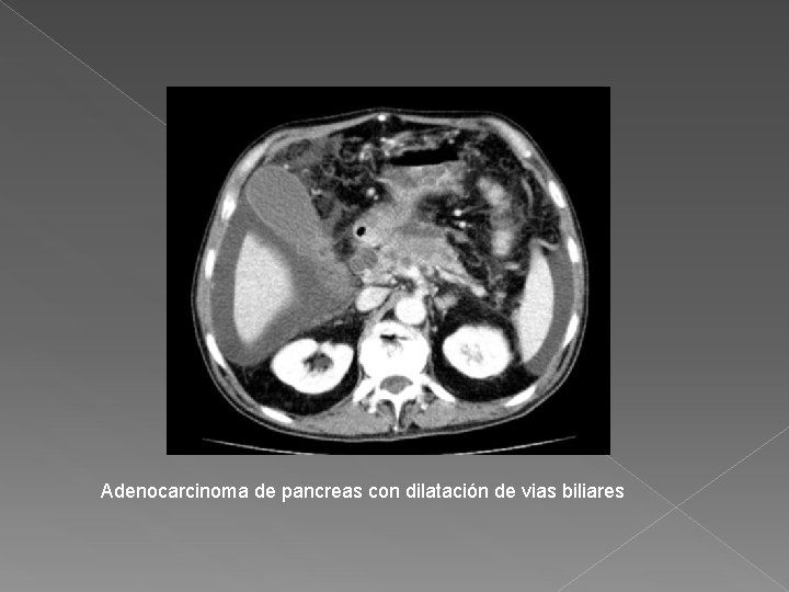 Adenocarcinoma de pancreas con dilatación de vias biliares 