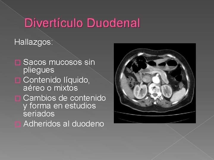 Divertículo Duodenal Hallazgos: Sacos mucosos sin pliegues � Contenido líquido, aéreo o mixtos �