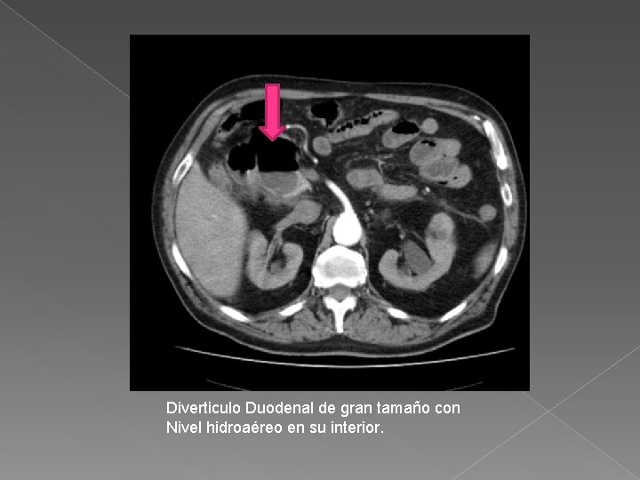 Diverticulo Duodenal de gran tamaño con Nivel hidroaéreo en su interior. 