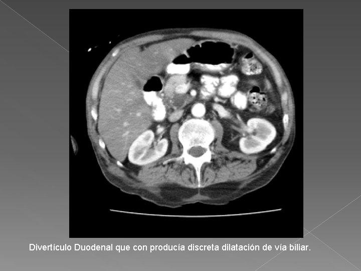 Divertículo Duodenal que con producía discreta dilatación de vía biliar. 