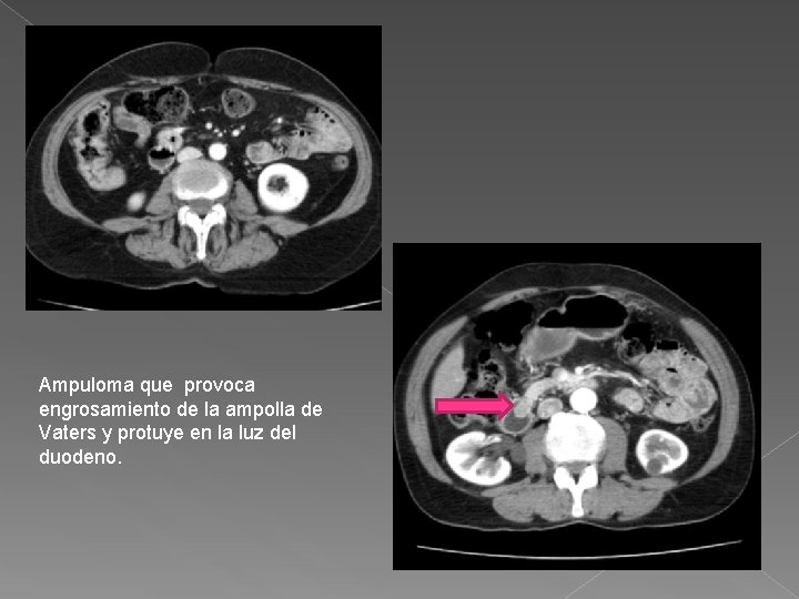 Ampuloma que provoca engrosamiento de la ampolla de Vaters y protuye en la luz