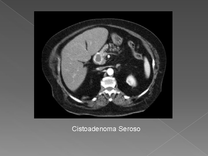 Cistoadenoma Seroso 