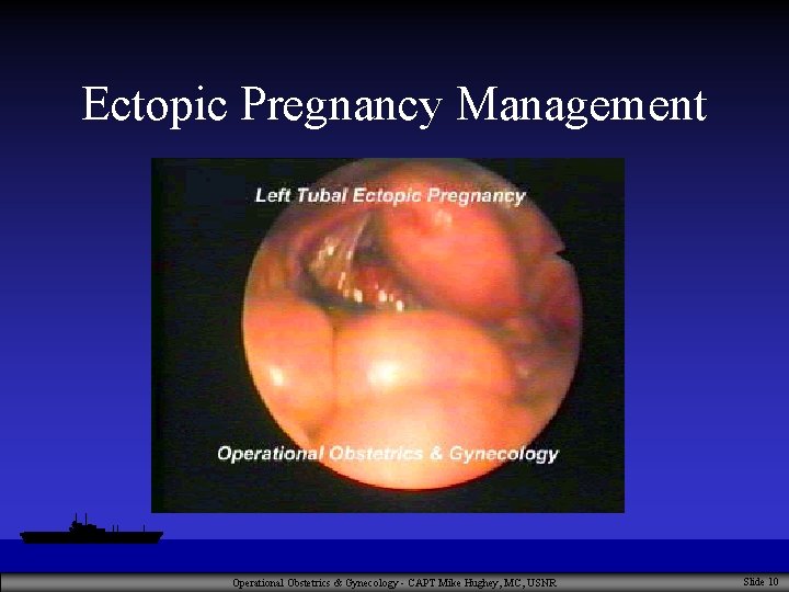 Ectopic Pregnancy Management Operational Obstetrics & Gynecology - CAPT Mike Hughey, MC, USNR Slide