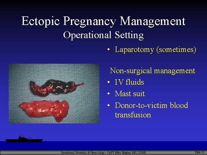 Ectopic Pregnancy Management Operational Setting • Laparotomy (sometimes) Non-surgical management • IV fluids •