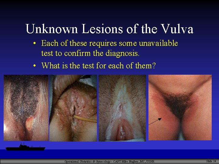 Unknown Lesions of the Vulva • Each of these requires some unavailable test to