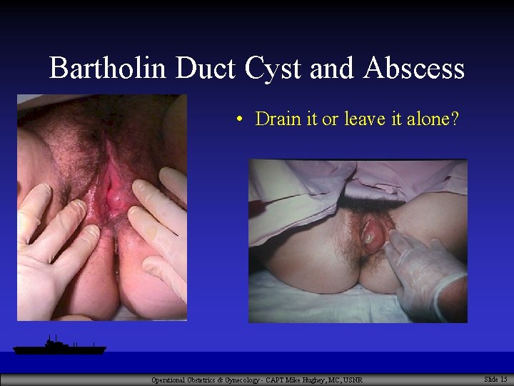 Bartholin Duct Cyst and Abscess • Drain it or leave it alone? Operational Obstetrics