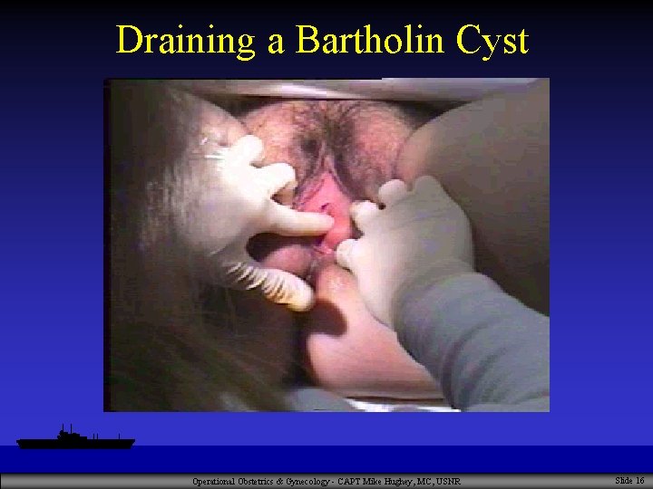 Draining a Bartholin Cyst Operational Obstetrics & Gynecology - CAPT Mike Hughey, MC, USNR