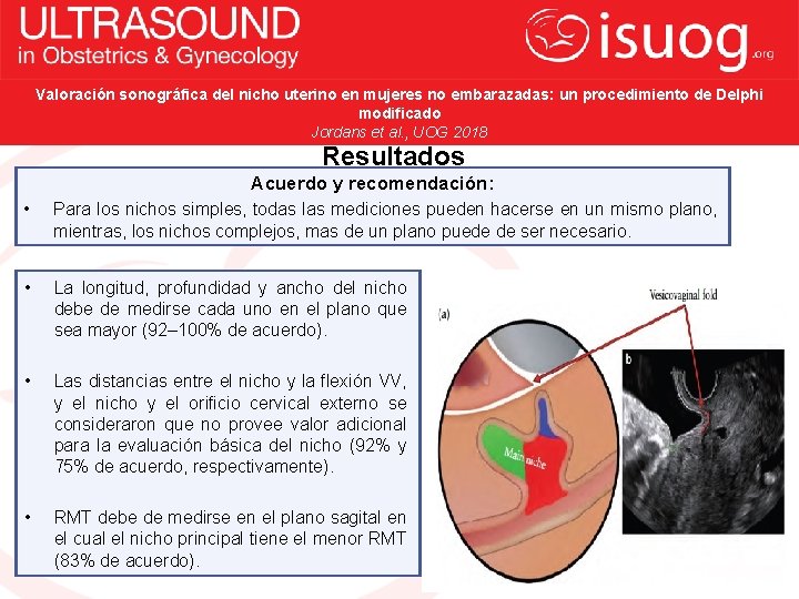 Valoración sonográfica del nicho uterino en mujeres no embarazadas: un procedimiento de Delphi modificado