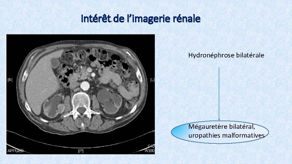 Intérêt de l’imagerie rénale Hydronéphrose bilatérale Mégauretère bilatéral, uropathies malformatives 