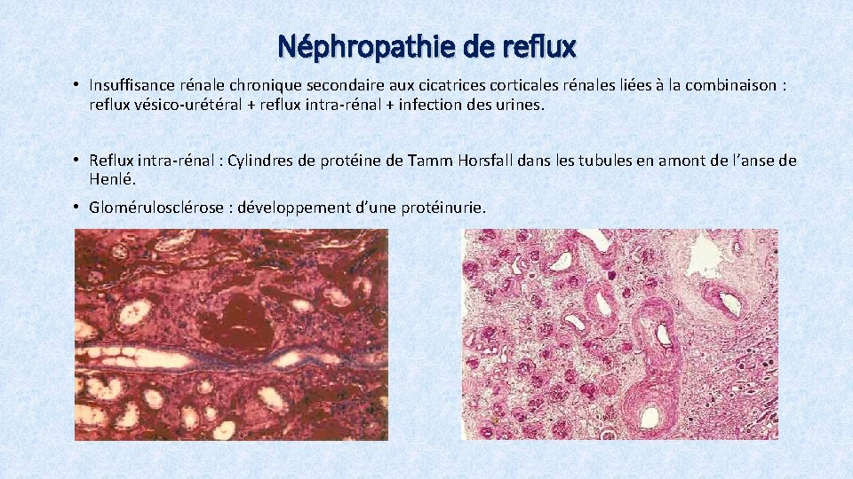 Néphropathie de reflux • Insuffisance rénale chronique secondaire aux cicatrices corticales rénales liées à