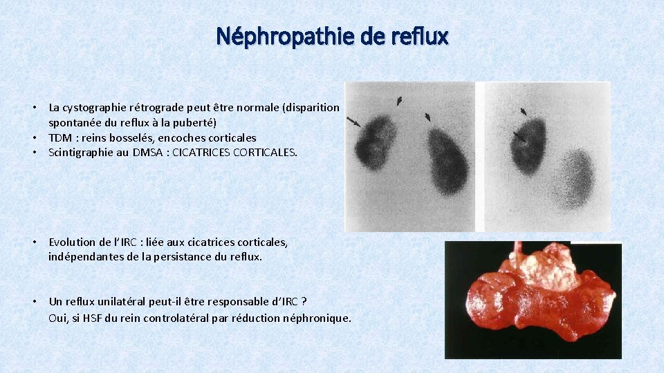 Néphropathie de reflux • La cystographie rétrograde peut être normale (disparition spontanée du reflux