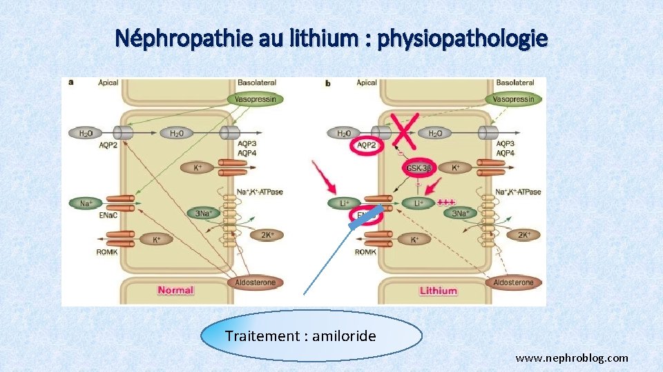 Néphropathie au lithium : physiopathologie Traitement : amiloride www. nephroblog. com 