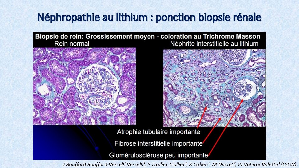 Néphropathie au lithium : ponction biopsie rénale J Bouffard-Vercelli¹, P Trolliet², R Cahen², M