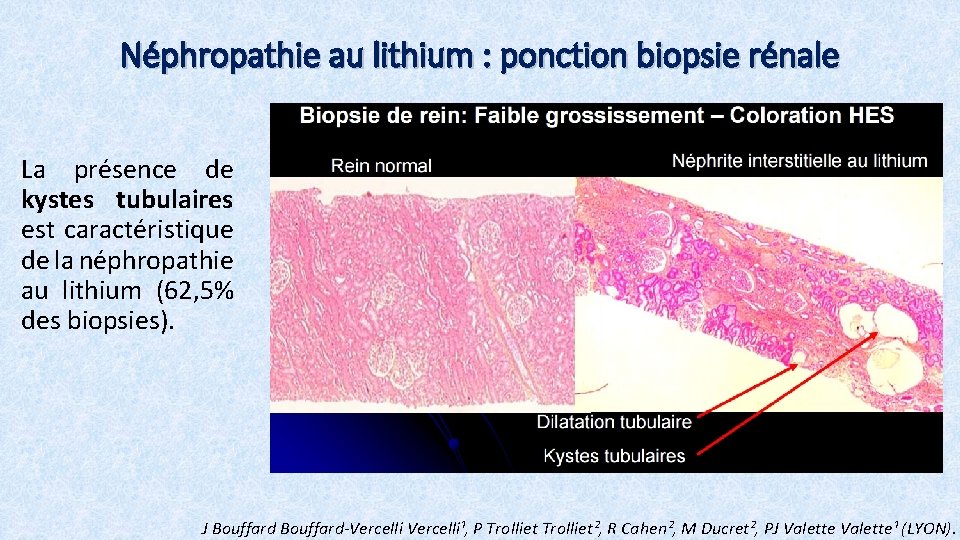 Néphropathie au lithium : ponction biopsie rénale La présence de kystes tubulaires est caractéristique