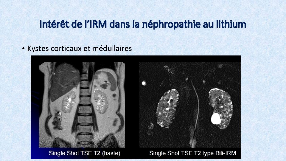 Intérêt de l’IRM dans la néphropathie au lithium • Kystes corticaux et médullaires 