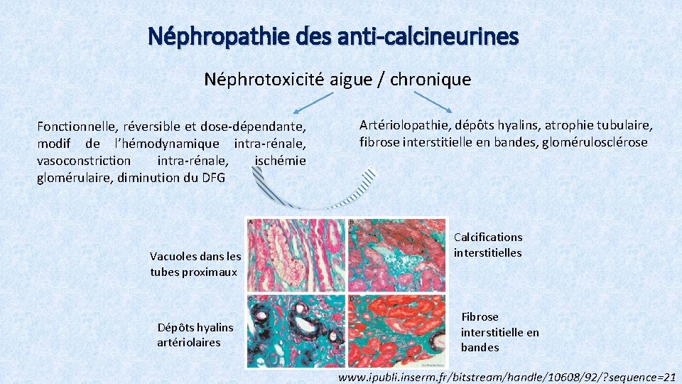 Néphropathie des anti-calcineurines Néphrotoxicité aigue / chronique Fonctionnelle, réversible et dose-dépendante, modif de l’hémodynamique