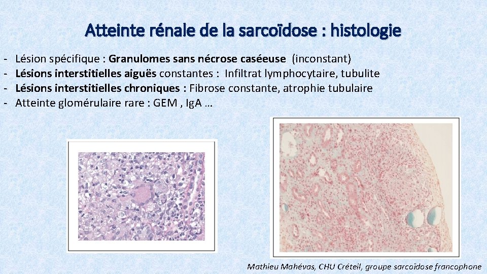 Atteinte rénale de la sarcoïdose : histologie - Lésion spécifique : Granulomes sans nécrose