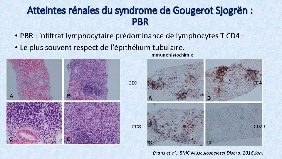 Atteintes rénales du syndrome de Gougerot Sjogrën : PBR • PBR : infiltrat lymphocytaire