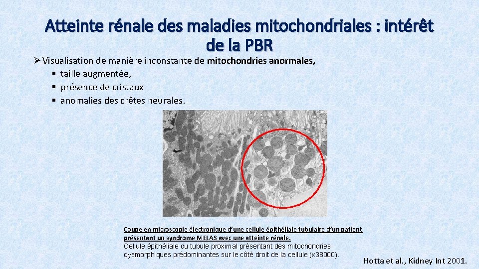 Atteinte rénale des maladies mitochondriales : intérêt de la PBR Ø Visualisation de manière