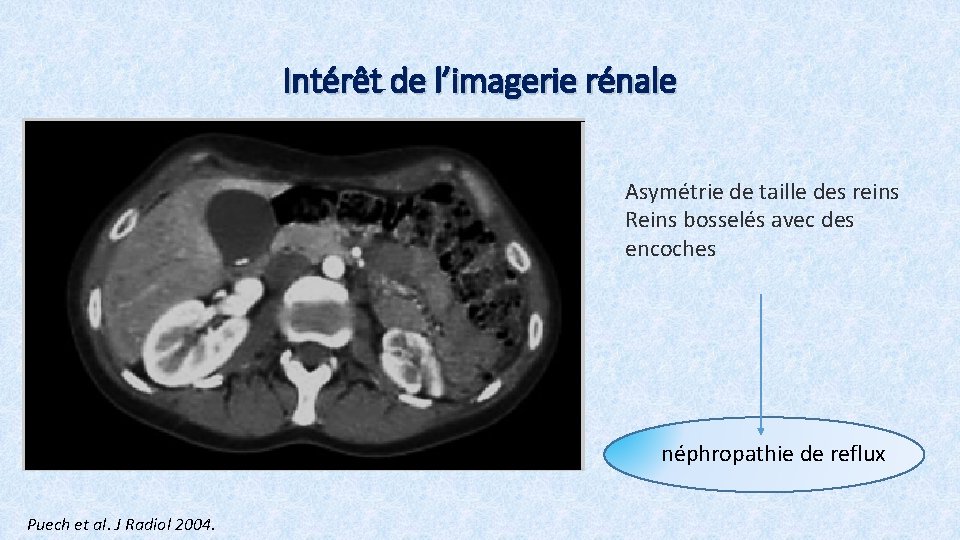 Intérêt de l’imagerie rénale Asymétrie de taille des reins Reins bosselés avec des encoches