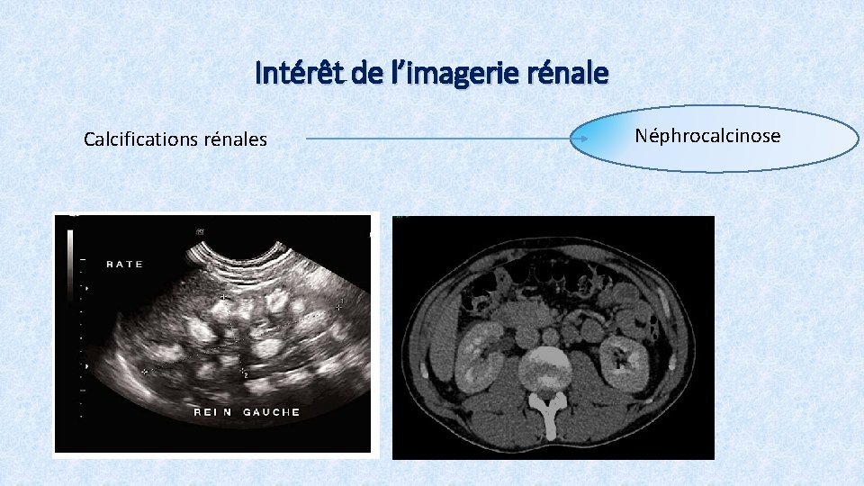 Intérêt de l’imagerie rénale Calcifications rénales Néphrocalcinose 