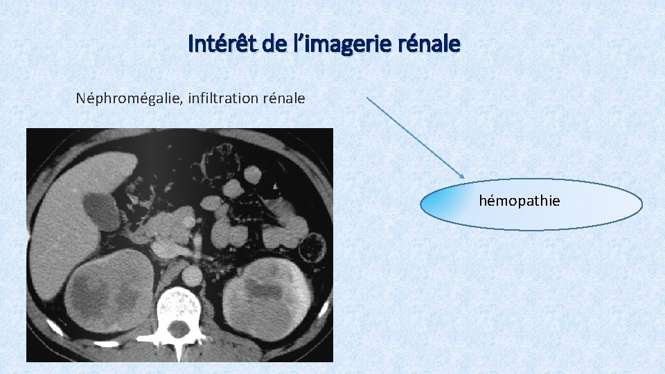 Intérêt de l’imagerie rénale Néphromégalie, infiltration rénale hémopathie 