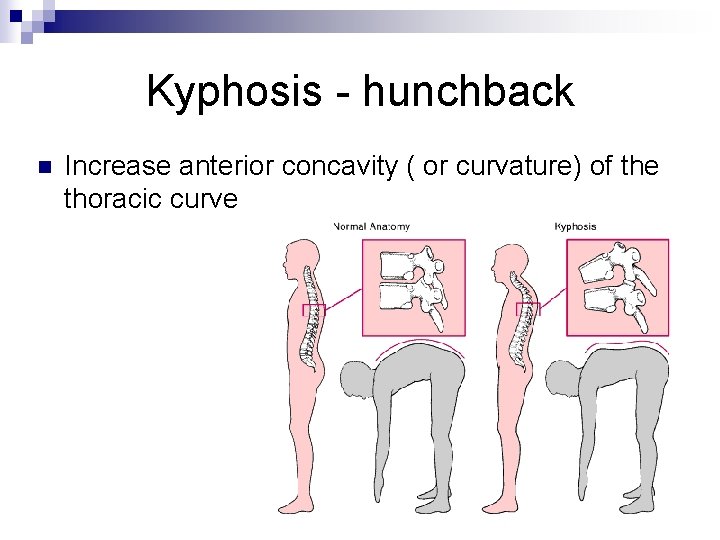 Kyphosis - hunchback n Increase anterior concavity ( or curvature) of the thoracic curve
