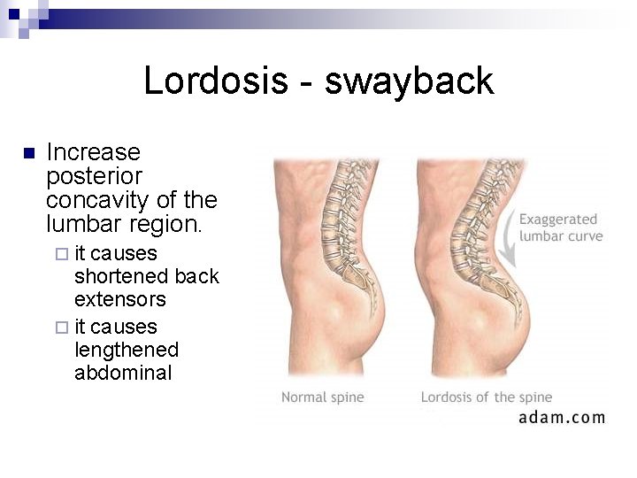 Lordosis - swayback n Increase posterior concavity of the lumbar region. ¨ it causes
